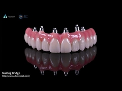 Υβριδικό ροζ πορσελάνινο εμφύτευμα Crown Malong Full Arch Implant Bridge άμεση φόρτωση