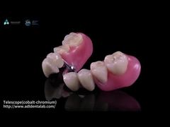 Τελεσκόπιο Εσωτερικό Co-Cr και Εξωτερικό Co-Cr Μεταλλικό με σύνθετο