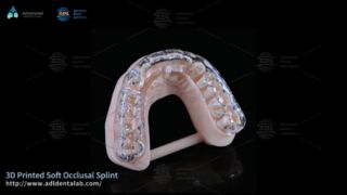 Προσαρμοσμένος 3D εκτυπωμένος νάρθηκας για άνεση κατά του βρουξισμού