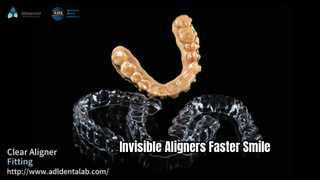 Invisible Aligners Πιο Γρήγορα Πιο Ευθεία Χαμόγελο