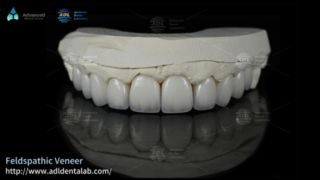 Feldspathic κεραμικοί καπλαμάδες υψηλής διαφάνειας για χαμόγελα