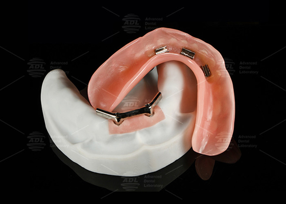 Αγορά Τιτανίου κράμα Snap On Dolder Implant Bar Overdenture γυαλισμένο για φυσικό χαμόγελο ηλεκτρονική κατασκευή