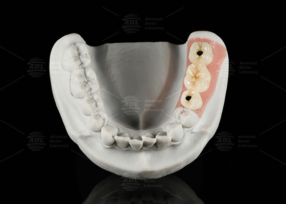Αγορά Στροφιά διατηρημένο τιτάνιο Custom Abutment πορσελάνη συγχωνευμένη με ζιρκόνιο ηλεκτρονική κατασκευή