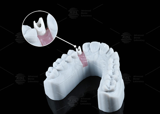 Αγορά Λευκό Custom Zirconia Abutment φυσική εμφάνιση αισθητική και βέλτιστη λειτουργικότητα ηλεκτρονική κατασκευή