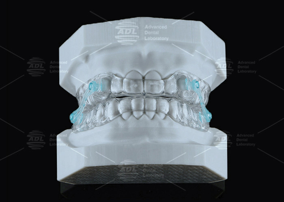 Αγορά Διαφανής Erkodent Silensor Anti Snoring Μύτη Custom Fit Μείωση θορύβου ηλεκτρονική κατασκευή