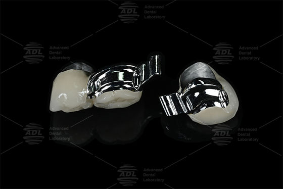 Αγορά Китайская зуботехническая лаборатория Регулируемый индивидуальный ключ для пациента Прецизионный аттачмент с PFM ηλεκτρονική κατασκευή