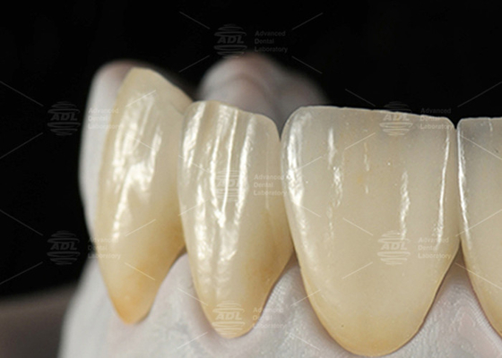 0.3mm-0.7mm Φελντσπάθικες ΕΜΑΧ Κερματικές Φανίρες Φυσικές Εσθητικές ΕΜΑΧ Οδοντικές Φανίρες