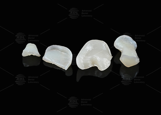 Διαφανές Onlay Zirconia Inlay για μακροχρόνια αντοχή σε λεκέδες και φθορά