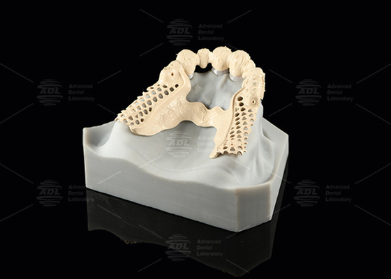 Φρέμα Milled Peek Προσαρμόσιμες ψηφιακές μερικές οδοντοστοιχίες Superior Thin
