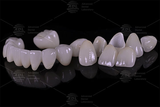 China Dental Lab Porcelain Fused To Zirconia High Strength Providing Tailored Services To International Dental Lab And Dentist